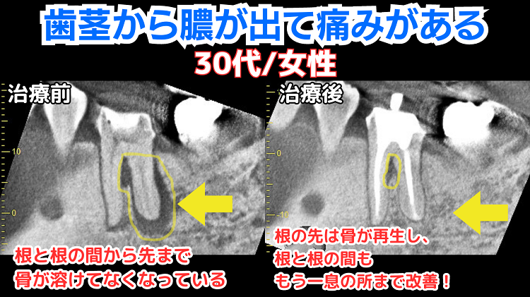 歯茎から膿が出て痛みがある　30代/女性